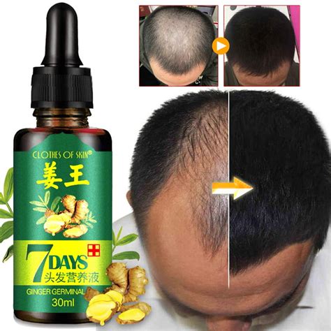 Alvage Ginger Germinal Oil Hair Growth Essential Oil Hair Loss Treatment For Thicker Dense Hair ...