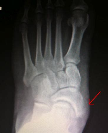 Accessory Navicular