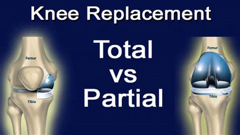 The Difference Between Total Knee Replacement And Partial Knee Replacement - YouTube