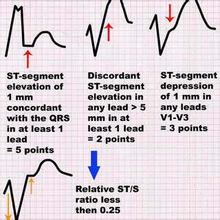 Sgarbossa and modified Sgarbossa criteria. At least 3 points of the ...