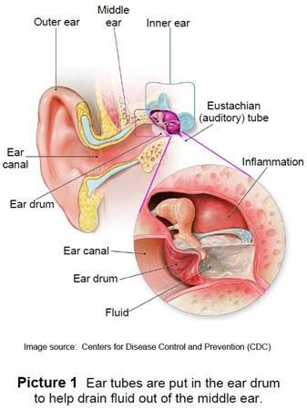 Tinnitus and Fluid Behind the Eardrum - Pulsatile Tinnitus