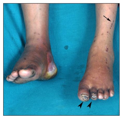 Diabetic Blisters (bullosis Diabeticorum)