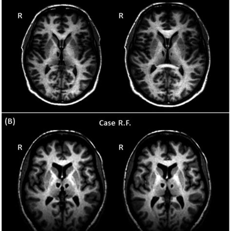 Bilateral thalamic damage detectable on T1-weighted images of the two ...