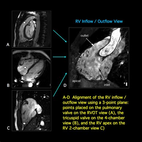 MRI BLOG: Cardiac MRI - Imaging Planes for Basic Cardiac Views