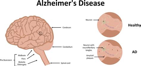 Breakthrough Study on the Cause of Alzheimer's - Premier Neurology ...