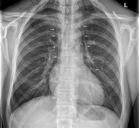 Spontaneous pneumomediastinum, Hamman's syndrome, with diabetic ketoacidosis - Kalaiah - 2017 ...