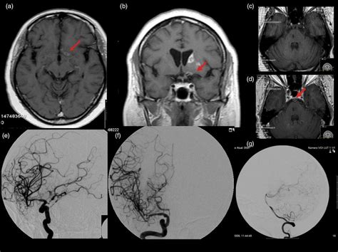 The diagnosis and overdiagnosis of cerebral vasculitis | Neupsy Key