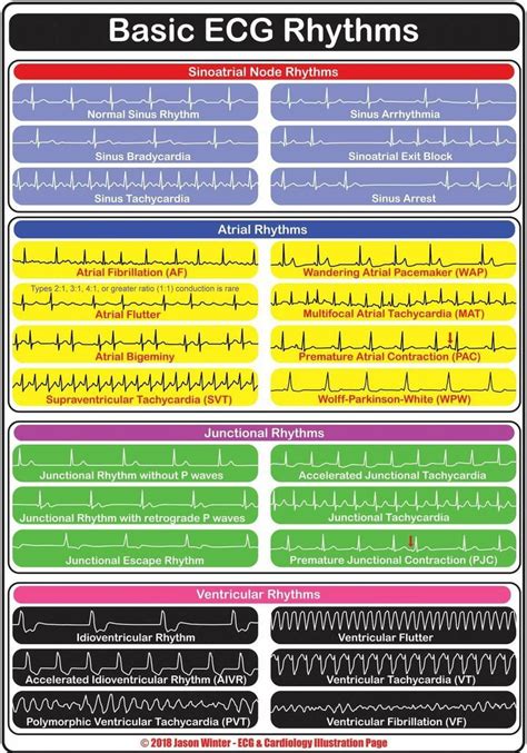 EKG rhythym | Emergency nursing, Icu nursing, Critical care nursing