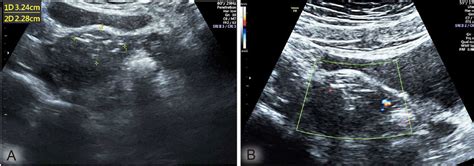 Sonography one month after the surgery: the myomectomy scar showed an... | Download Scientific ...