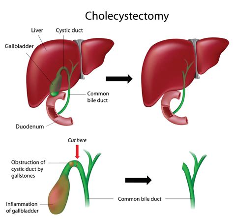 Gallbladder Surgery | Bile Ducts Surgery | Weightloss Operations