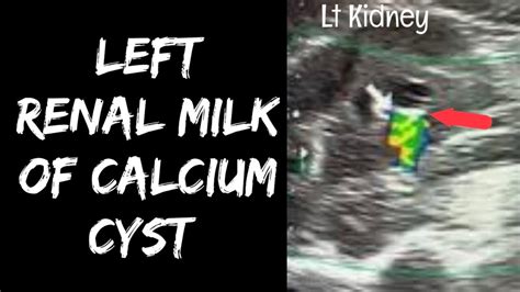 Left Renal Milk of Calcium Cyst - YouTube