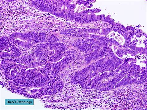 Qiao's Pathology: Gastric Adenocarcinoma, Intestinal Type | Flickr