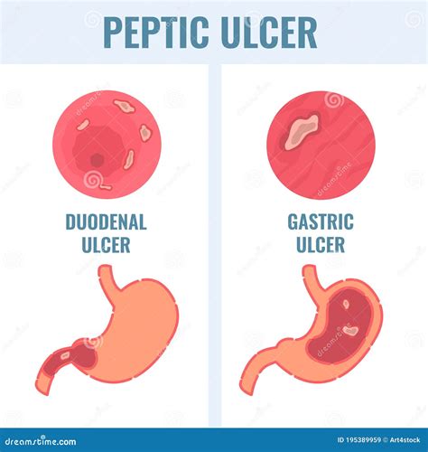 Duodenal and Gastric Types of Peptic Ulcer Stomach Disease Stock Vector - Illustration of health ...