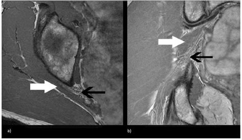 Sciatic Foramen Mri