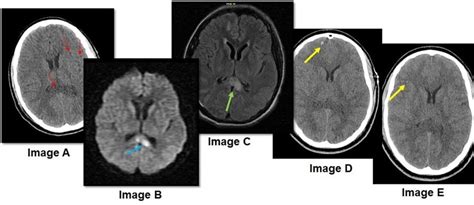 Diffuse axonal injury (DAI) Image A: Axial CT image with no IVC/... | Download Scientific Diagram