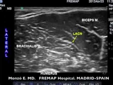 Entrapment Of The Lacn Lateral Antebrachial Cutaneous - vrogue.co