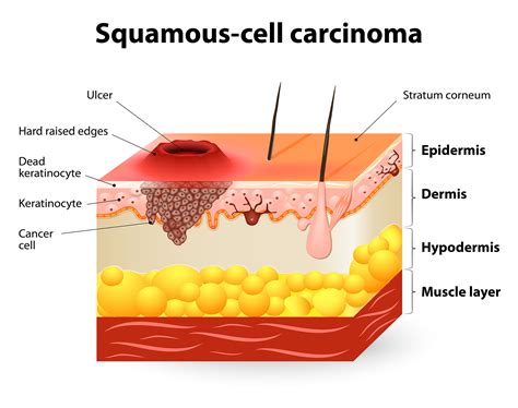 Squamous Cell Carcinoma (SCC) - CBD Skin Cancer Clinic