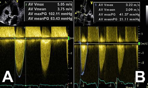 a Echocardiography of a patient with normal-flow, high-gradient aortic... | Download Scientific ...