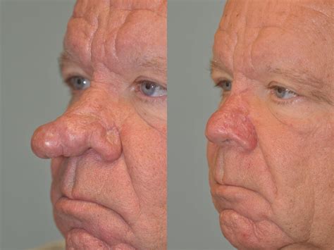 Rhinophyma after treatment with Laser | Eugene Alford | Flickr