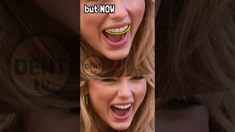 Taylor Swift Before And After Teeth