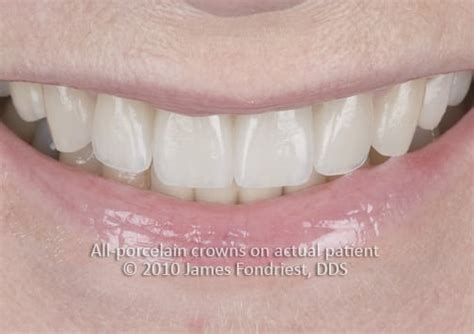 Types of Dental Porcelain Crowns