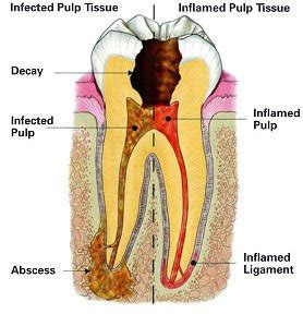 Dentist Cosmetic: Wisdom tooth bacterial infection