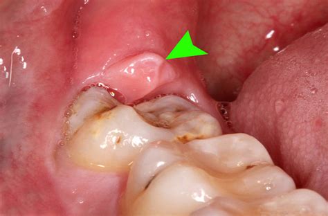 Wisdom Tooth - Do we need to remove it! - French Dental Services - Dr.Miski