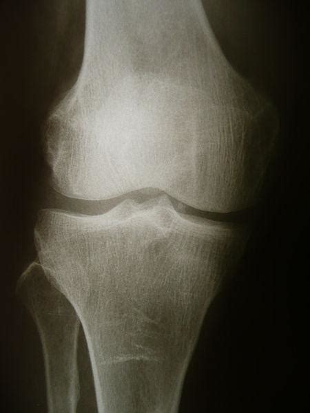 What Is A Bone Spur And Treatment