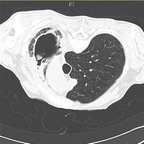 Cavitating Lung Lesion and Recurrent Chest Infections