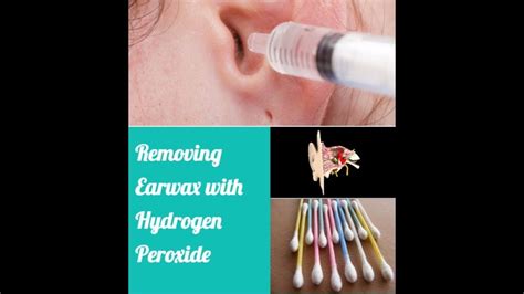 How To Use Hydrogen Peroxide Eardrop To Remove Impacted Ear Wax Buildup | Ear wax buildup ...