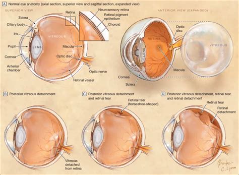 Normal Eye Anatomy, PVD, Retinal Tear, and Retinal Detachment | Download Scientific Diagram