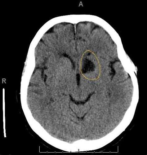 Occlusion of recurrent artery of Huebner with caudate nucleus infarct | Radiology imaging ...