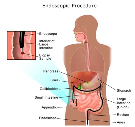 Gas in the Digestive Tract | Johns Hopkins Medicine