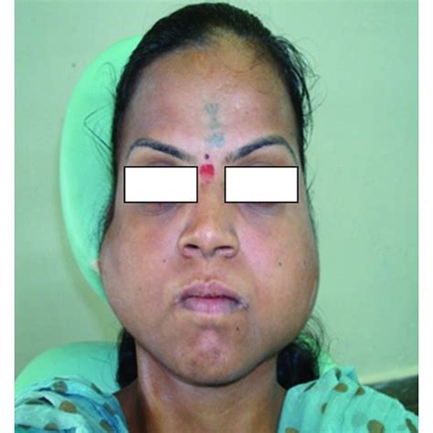 The figure shows frontal bossing, broad nasal bridge, hypertelorism,... | Download Scientific ...