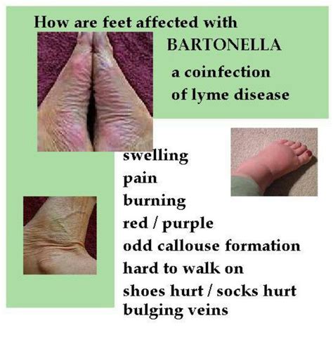 Bartonella | Lyme disease awareness, Lyme disease treatment, Disease awareness