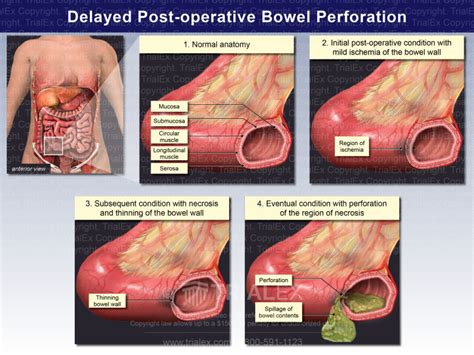 Delayed Post-operative Bowel Perforation - TrialExhibits Inc.