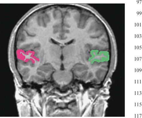 (Open Access) MRI Assessment of Superior Temporal Gyrus in Williams ...