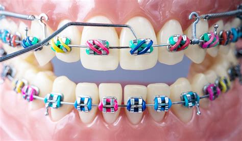 Orthodontist in Lancaster | Orthodontist in Lititz