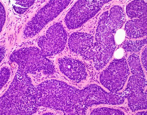 Pathology Outlines - Eccrine spiradenoma