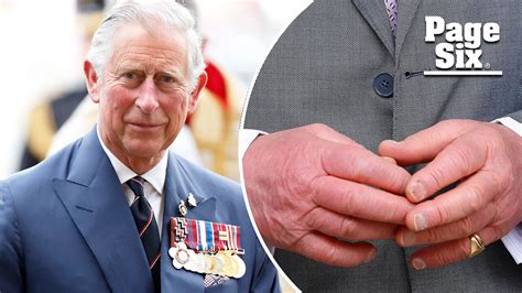 King Charles III's hands turn red and raw amid Wales greetings