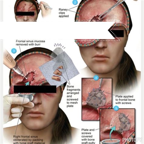 Sinus Obliteration Surgery