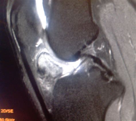 Pigmented Villonodular synovitis (PVNS) - Sumer's Radiology Blog