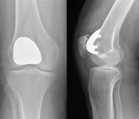 Patellofemoral Syndrome X Ray