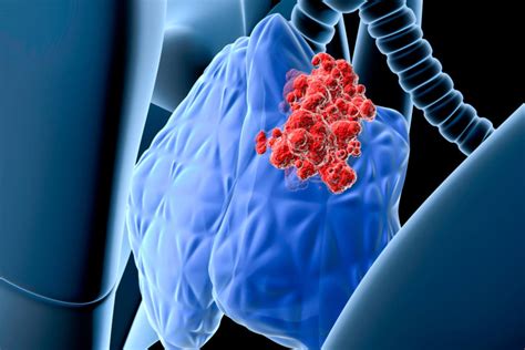 Postoperative Radiotherapy Favorable as Adjuvant Treatment for Thymic Neuroendocrine Tumors ...