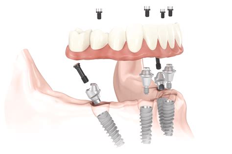 All-on-4® Dental Implants | Houston TX | J. Robert Friedberg