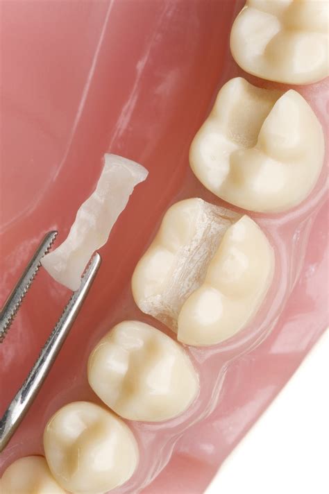 5 Facts About Dental Inlays & Onlays - Channo DDS
