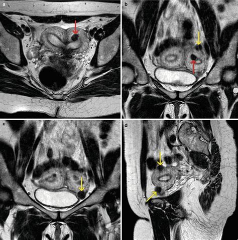 Uterus Anatomy Mri