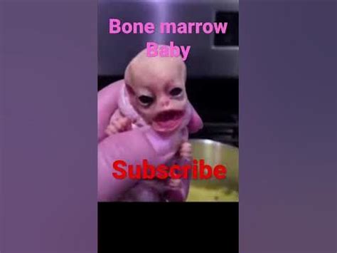 Bone marrow Baby. 😢 sad - YouTube