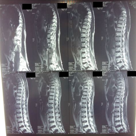 Contrast thoracolumbar MRI shows wedge fracture of the 6th thoracic ...