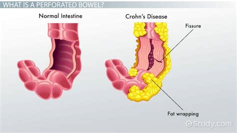 Perforated Bowel | Definition, Symptoms & Causes - Video & Lesson Transcript | Study.com